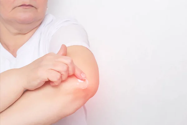 A woman rubs an anti-inflammatory treatment ointment into the elbow joint to relieve pain and inflammation, treatment of the elbow joint with a cream, chondrocalcinosis, copy space — Stock Photo, Image