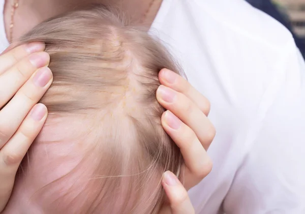 Dermatitis seborreica por dermatitis fúngica en la cabeza de un niño, primer plano, corteza seborreica, dermatología —  Fotos de Stock