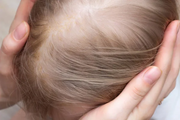 Dermatitis seborreica por dermatitis fúngica en la cabeza de un niño, primer plano, corteza seborreica, dermatología — Foto de Stock