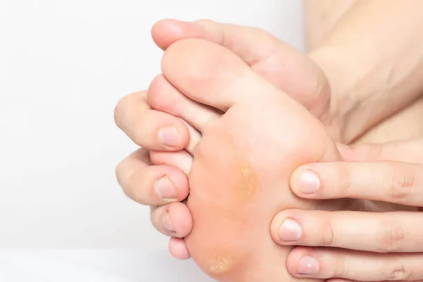 Man shows problem skin on the foot and sole of the foot dry and callous skin with mazols with a stem, close-up, copy space, disease — Stock Photo, Image