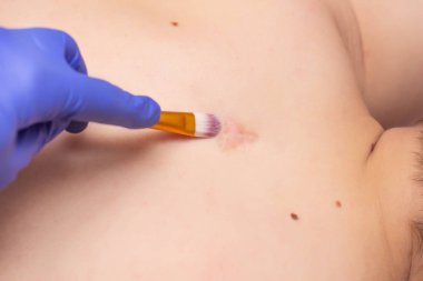 Doktor kozmetolojist, yaranın en hızlı şekilde geri dönmesi için hastaya bir yara izi ve bir yara izi için kimyasal peeling uygular.