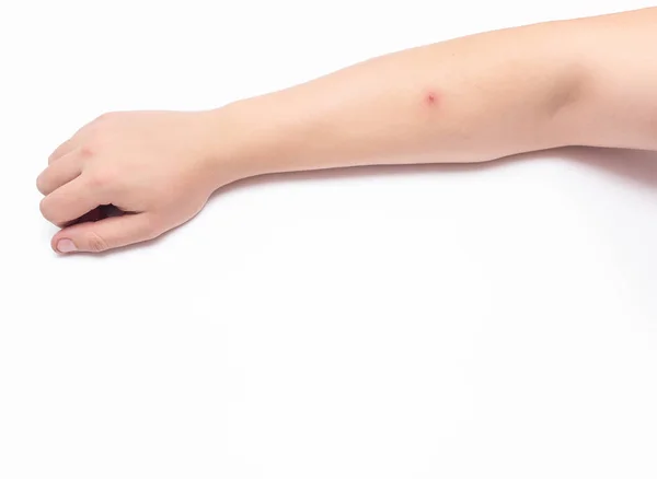 Bouton rouge douloureux sur la main d'une personne, fond blanc, gros plan, espace de copie, inflammation — Photo