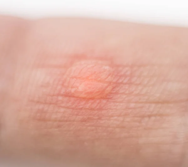 Maíz rojo húmedo hidropesía en el dedo en la mano, macro, callo en la piel, inflamación — Foto de Stock