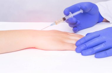 Bir doktor, ağrı ve iltihabı, modern prosedürü, anesteziyi ortadan kaldırmak için bileğindeki genç kıza plazma terapisi enjekte ediyor.