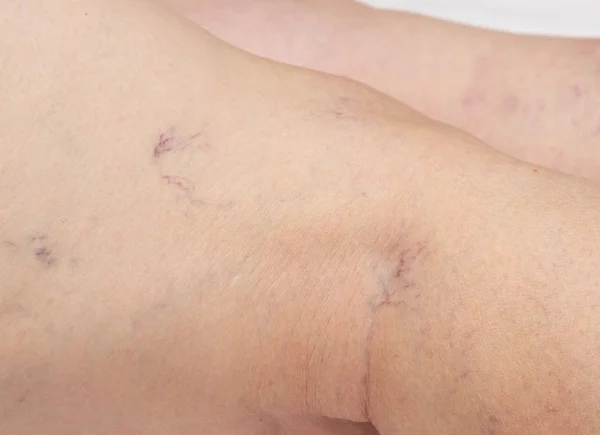 Varicose veins in the legs of an elderly woman, close-up, spider veins on the skin, thrombophlebitis