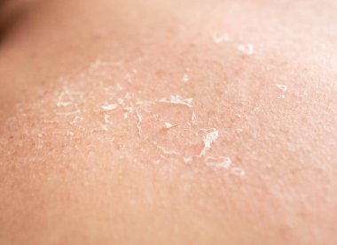 Bir kişinin sırtında güneş yanığı sonra deri flaking, güneş yanığı, yakın çekim, epidermis