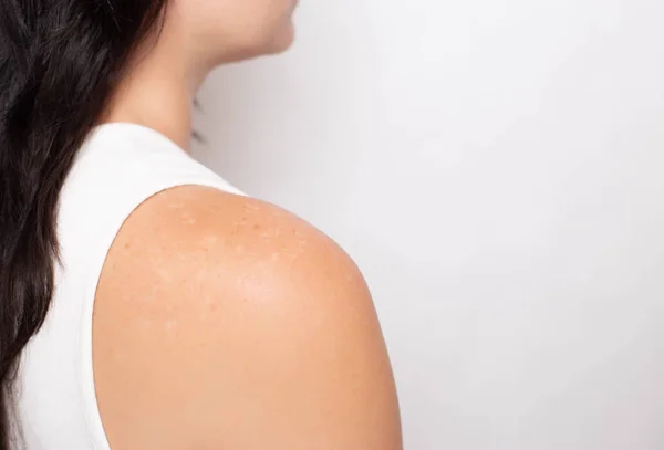 Problema de piel con manchas pigmentadas en el hombro de la niña sobre un fondo blanco, médico, espacio para copiar, trastornos hormonales — Foto de Stock