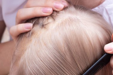 Anne bebek s kafa, yakın çekim, Seborrhoeic Dermatit, inflamatuar Seboreik kabuk penye