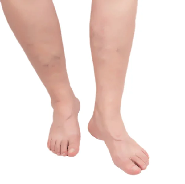 Veias varicosas em pernas de mulheres idosas em um fundo branco, isolar, trombose — Fotografia de Stock