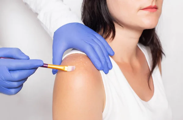 Doktor kosmetolog gör kemisk peeling av en flicka på problem hud på hennes axel, som har pigmenterade fläckar. Hudpigmentering behandling Beauty Saloon — Stockfoto