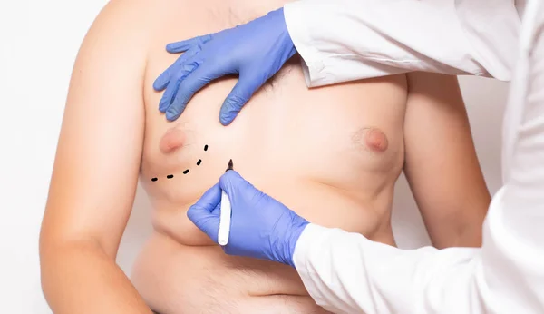 Doktor plastik cerrah hazırlık ameliyat öncesi erkeklerde meme azaltmak için, jinekomasti, lipoliz