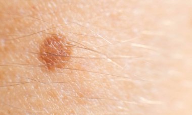 İnsan derisinde küçük bir leke, karsinom. Arkaplan, makro