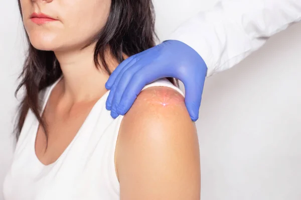 Врач-косметолог удаляет пигментные пятна на коже девушки лазером. Лазерное лечение пигментации кожи человека, крупным планом — стоковое фото