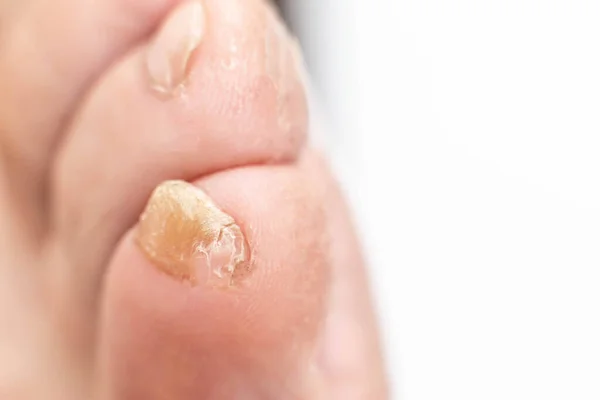 Fungus on the foot, on the toe of a person, macro, copy space, contagion — Stock Photo, Image