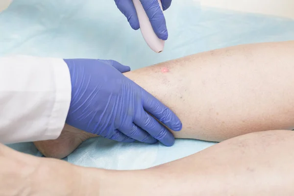 Uzman doktor alt uzuvların damarlarında endovenöz lazer pıhtılaşması yapıyor. Varis ve tromboz için tedavi kavramı