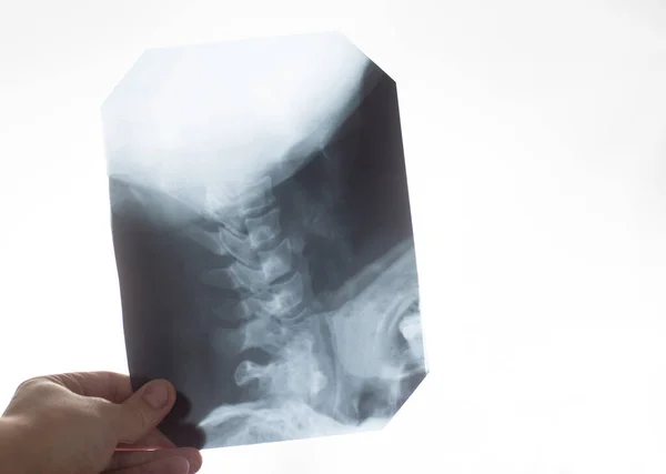 Врач держит в руке рентгеновский снимок шейного отдела позвоночника пациента. Понятие болезней шеи, остеохондроза, дегенеративных изменений позвоночника, пространства для копирования, ортопедии. — стоковое фото