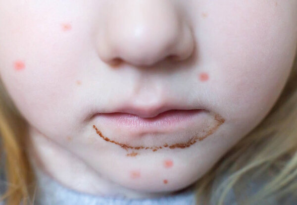 girl s dirty mouth from chocolate and sweets, red pimples on her face. The concept of childhood allergies to sweets, close-up, treatment