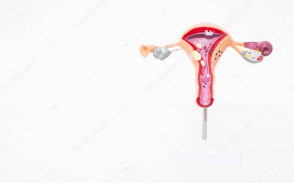 Mock female reproductive system on a white background. The concept of sexually transmitted infections, bacterial vaginosis