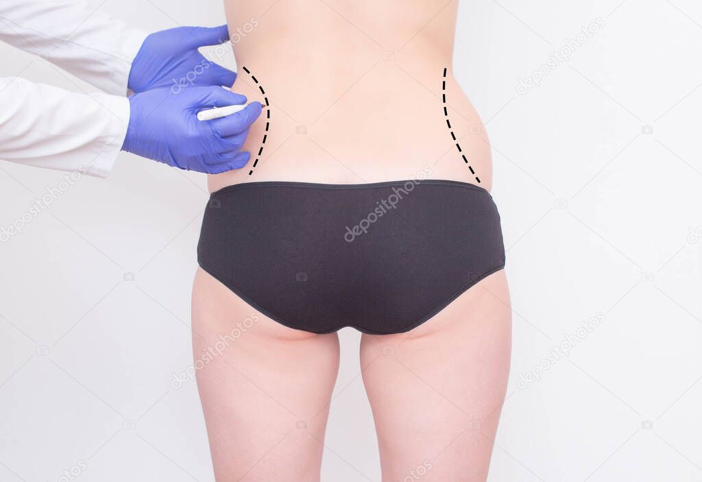 Doctor plastic surgeon marks with a felt-tip pen tags for plastic surgery to remove fat from the sides and waist of a girl, laser