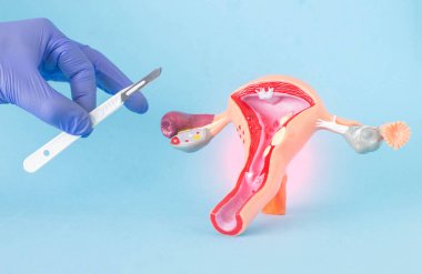 Doktor cerrah kadın üreme sisteminin arka planına karşı cerrahi bir neşter tutuyor. Kadınlardaki polip ve kistlerin alınması için vajinal plastik, kürtaj, cerrahi operasyonlar, histeroskopi kavramı