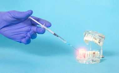 Doktor diş çene sakızına bir enjeksiyon yapar. Karaciğer ve pulpitis tedavisi için anestezi enjeksiyonu kavramı, iltihaplanma süreci, yatıştırma
