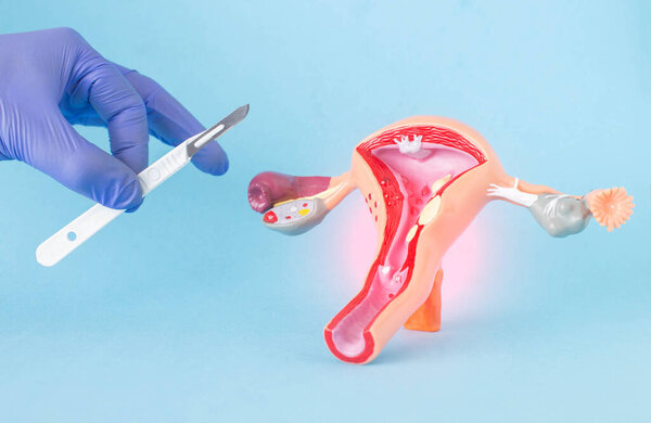 Doctor surgeon holds a surgical scalpel against the background of the layout of the female reproductive system. Concept of vaginal plastics, abortion, surgical operations to remove polyps and cysts in women, hysteroscopy