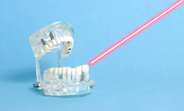 Modelo Mandíbula Dentária Fundo Azul Com Laser Conceito Tratamento Cárie — Fotografia de Stock