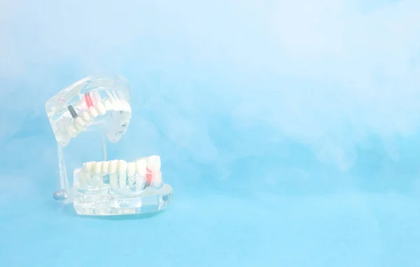 Modelo de mandíbula dental sobre fondo azul con ozono. Tratamiento de la pulpitis dental y la caries. Una manera indolora de tratar los dientes y la cavidad oral, copiar el espacio para el texto — Foto de Stock