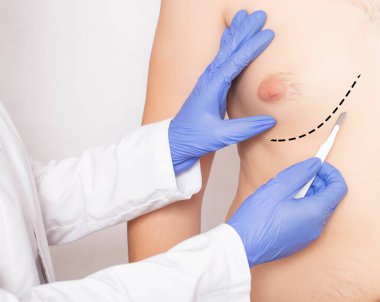 Erkek hastaların göğsünde neşter tutan doktor plastik cerrah. Erkek Göğüs ve Göğüs Ucu Azaltma Konsepti, yakın plan.