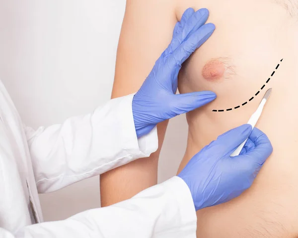 Erkek hastaların göğsünde neşter tutan doktor plastik cerrah. Erkek Göğüs ve Göğüs Ucu Azaltma Konsepti, yakın plan.