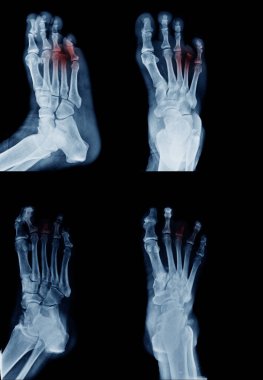 Amputee ayak x-ray görüntü birçok görünüm ve birçok durumda 