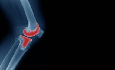 x-ray görüntü Tka afiş ve metin coppy yeri olan mavi ses tonuyla