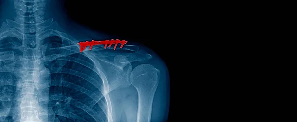 x-ray image and banner design of shoulder in blue tone with black background, post operation clavicle fracture and fixed