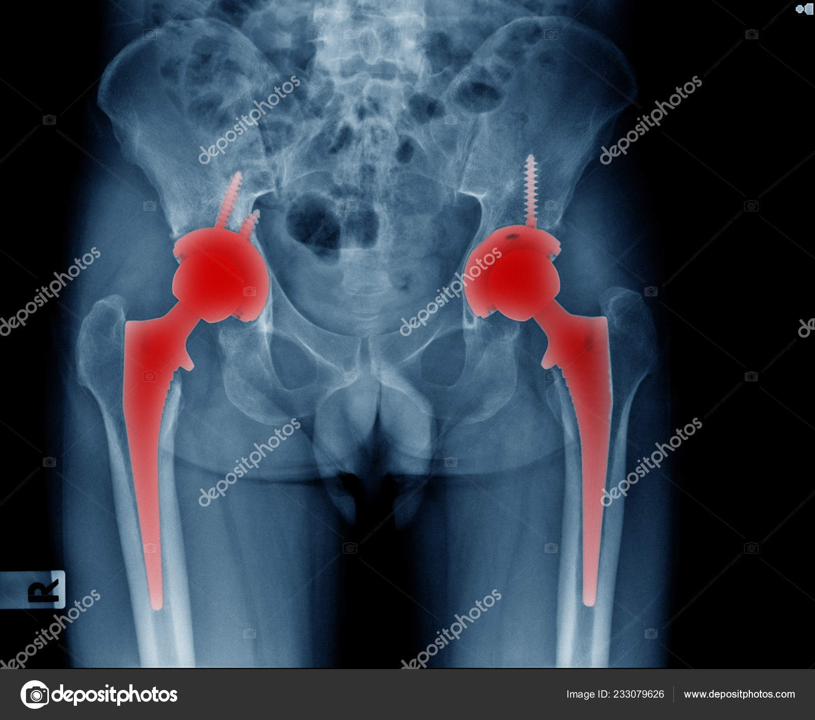 Bilateral Hip Replacement Patient Hight Qulity Ray Image Hip Joint