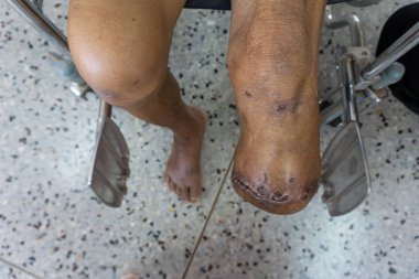 şeker hastalığı sabırlı yazı amputee işlemi ile sol güdük kadar diz amputasyon kapatın 