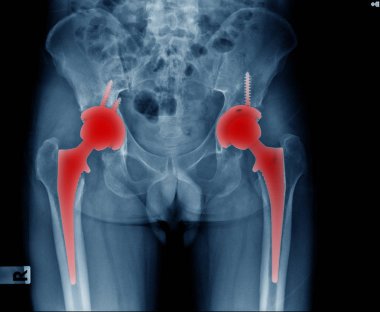 bilateral hip replacement of patient, hight qulity x-ray image of hip joint replacement both side in blue tone with black background  clipart