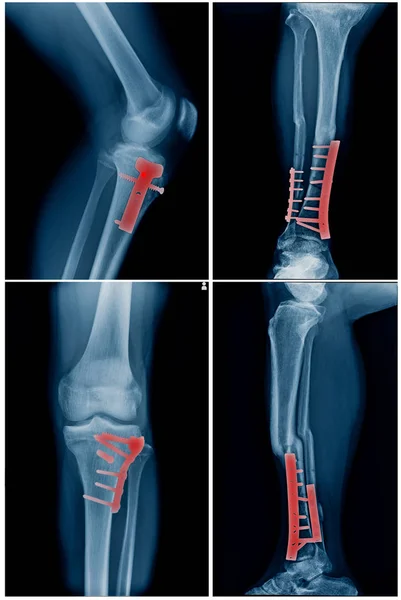 Collection Leg Post Operation Internal Fixation Tibia Fibular Bone — Stock Photo, Image