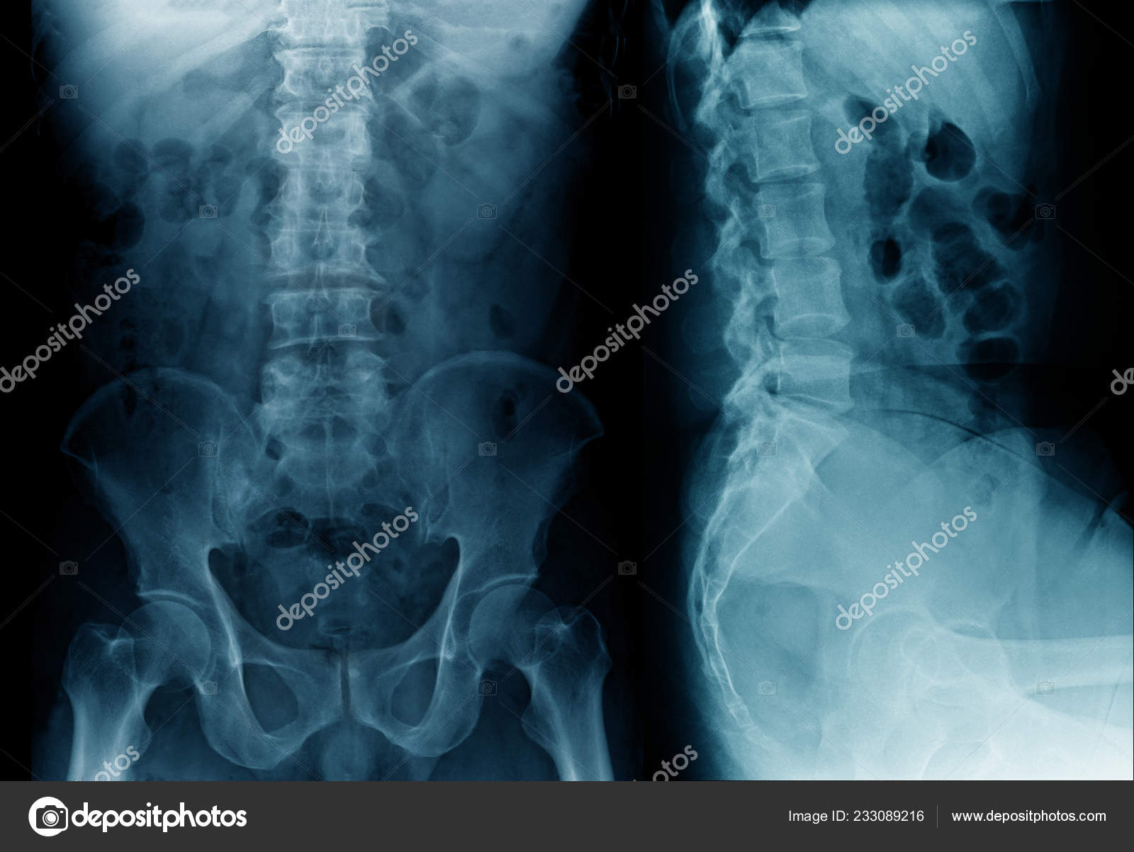 Raio Toraco Lombar Lat — Foto © Tridsanu #233089216, image size:1600x1202