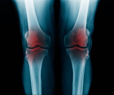 x-ray görüntü göstermek Oa diz yaşlı adam 