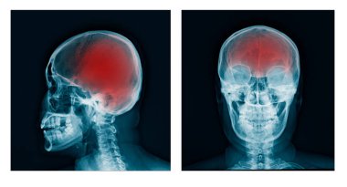 kafatası x-ray Ap/Lateral görünüm