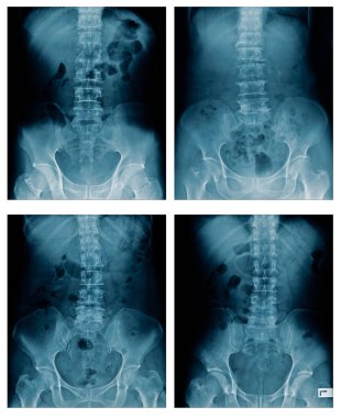 koleksiyon omurga x-ray görüntü 