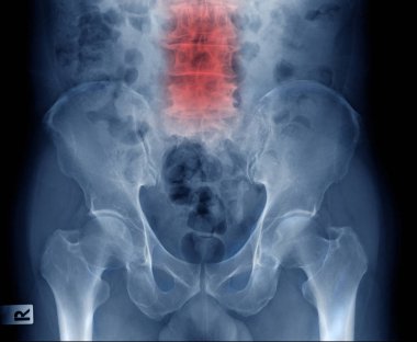 Lomber x-ray göstermek dejeneratif değişim ve vücut lomber mahmuz 