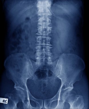 Lomber spondiloz x-ray görüntü kaliteli görüntü 