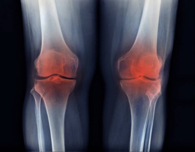 osteoartrit diz x-ray görüntü, yüksek kaliteli Oa diz Pa görünümü 