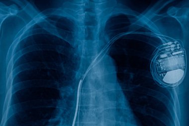 kalp pili hücre x-ray görüntü