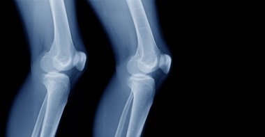 x-ray knee lateral view  clipart