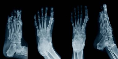 collection foot x-ray  clipart