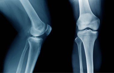x-ışını Oa diz x-ray 