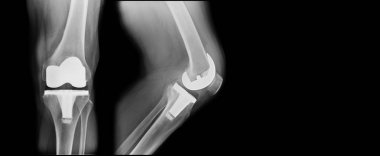 TKA x-ray, total diz değiştirme ön ve yan görünüm
