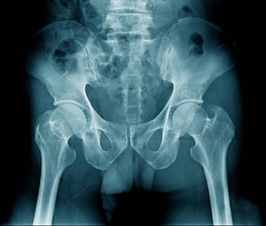 kalça ve pelvik kemik x-ray 